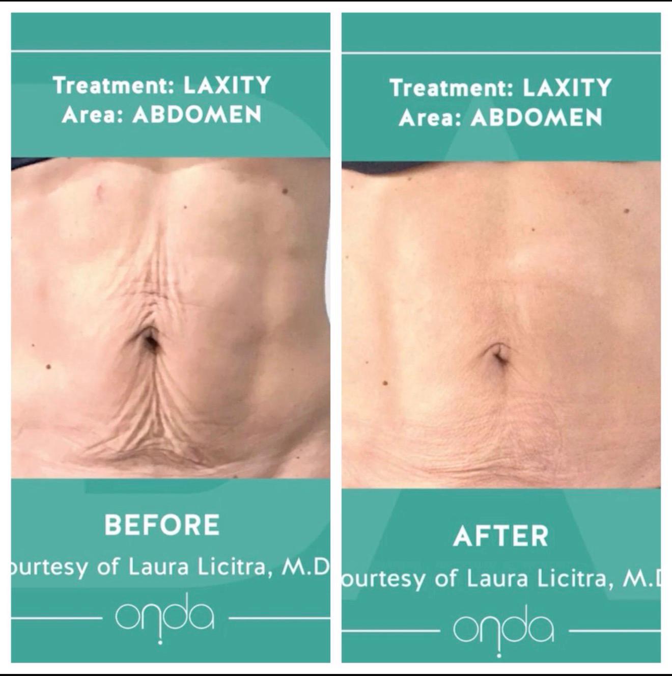 Abdomen skin tightening before and after