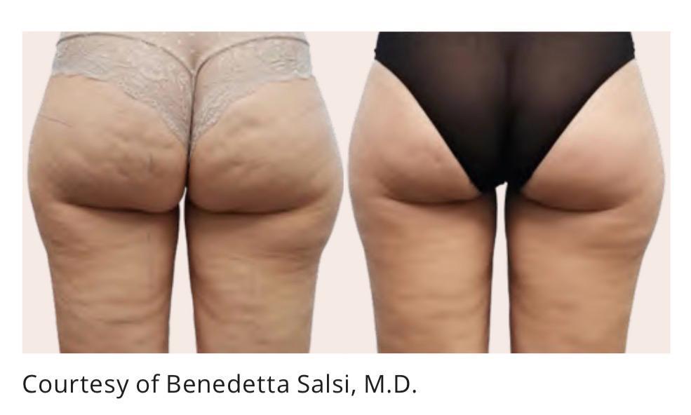 Cellulite reduction before and after