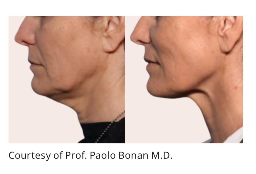 Jawline contouring before and after